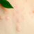 Peeling z kwasem salicylowym – skuteczny sposób na trądzik i blizny